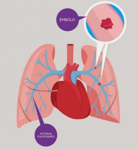 embolismo-pulmonar