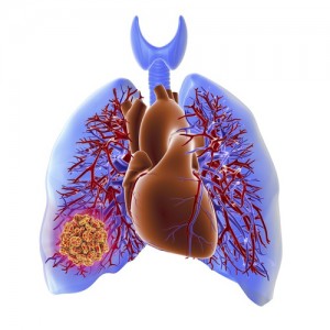 borrador embolismo pulmonar fotolia